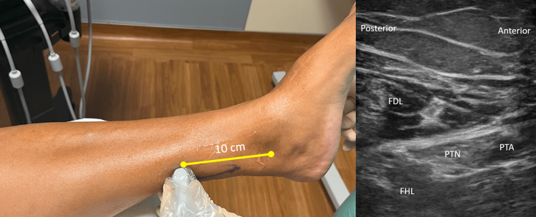 A la izquierda, colocación de la sonda 10 cm sobre el maléolo interno; a la derecha, ecografía con el nervio tibial posterior (NTP) junto a la arteria tibial posterior (ATP), entre los tendones flexores (FDL y FHL)