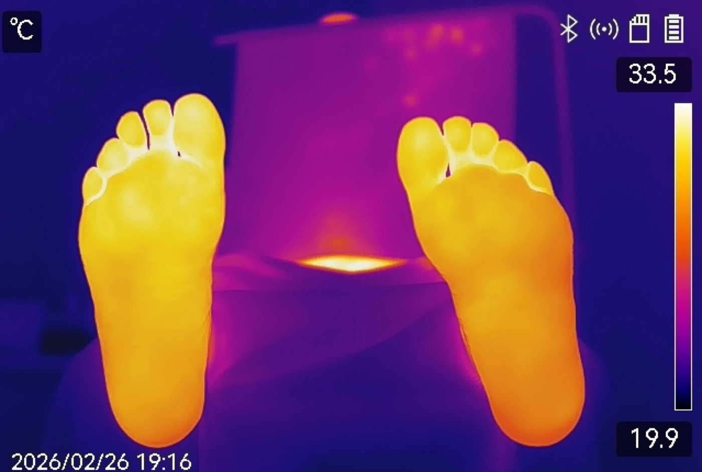 Termografía infrarroja de pie diabético — detección precoz de zonas de riesgo y úlceras por temperatura en podología La Laguna Tenerife