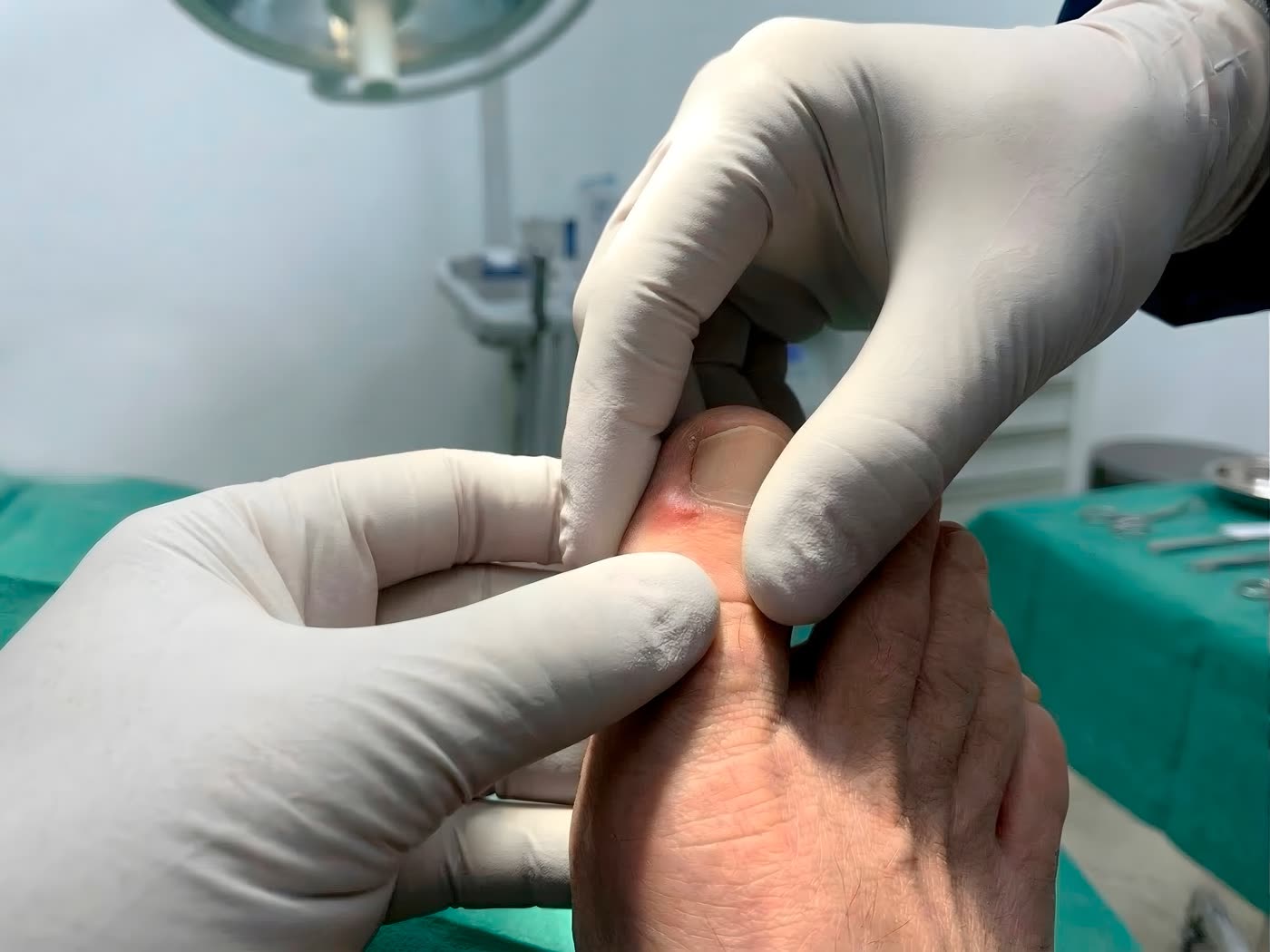 Cirugía ungueal mínimamente invasiva para uña encarnada — podólogo especialista en La Laguna Tenerife