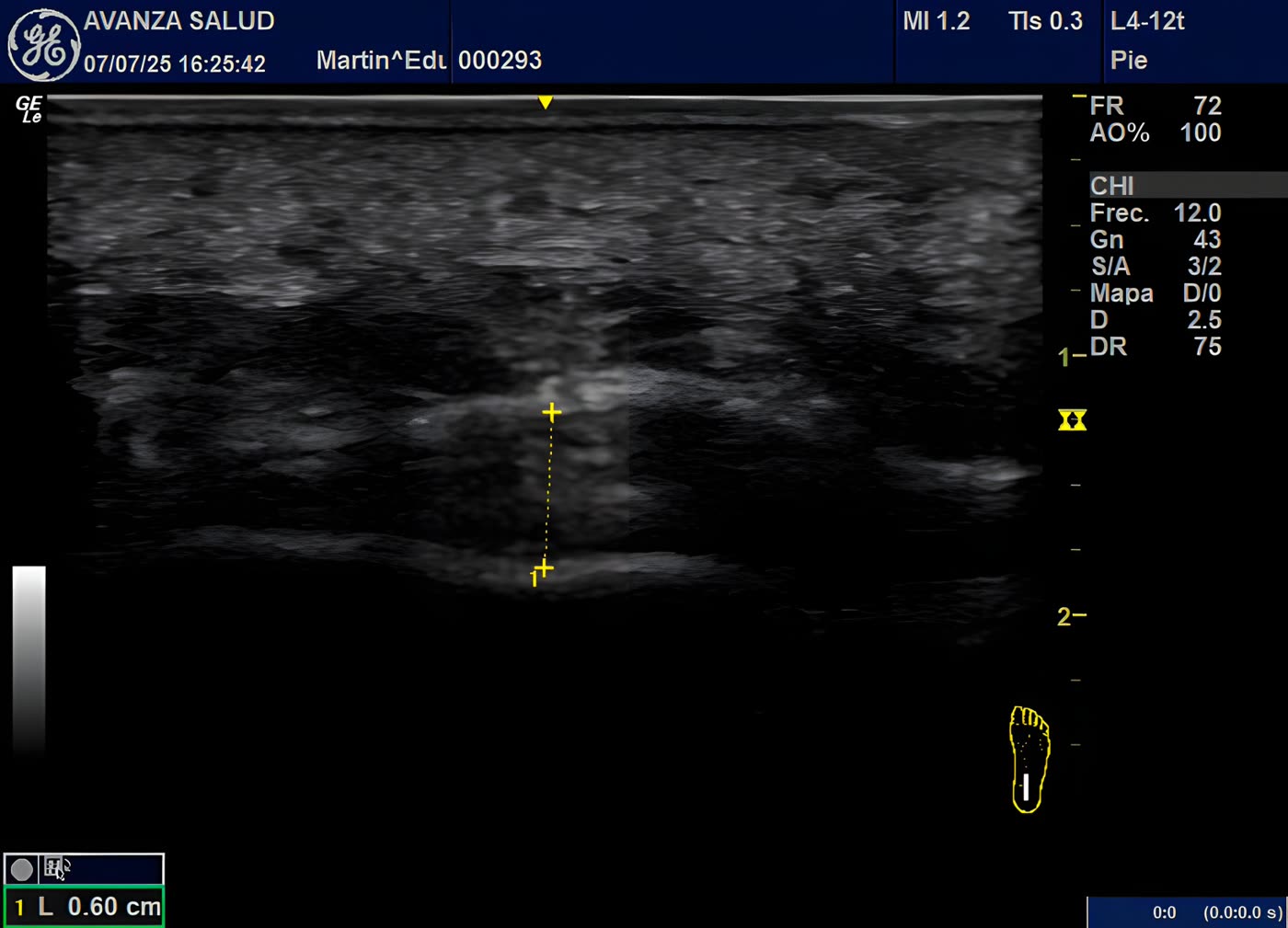 Ecografía músculo-esquelética en fisioterapia