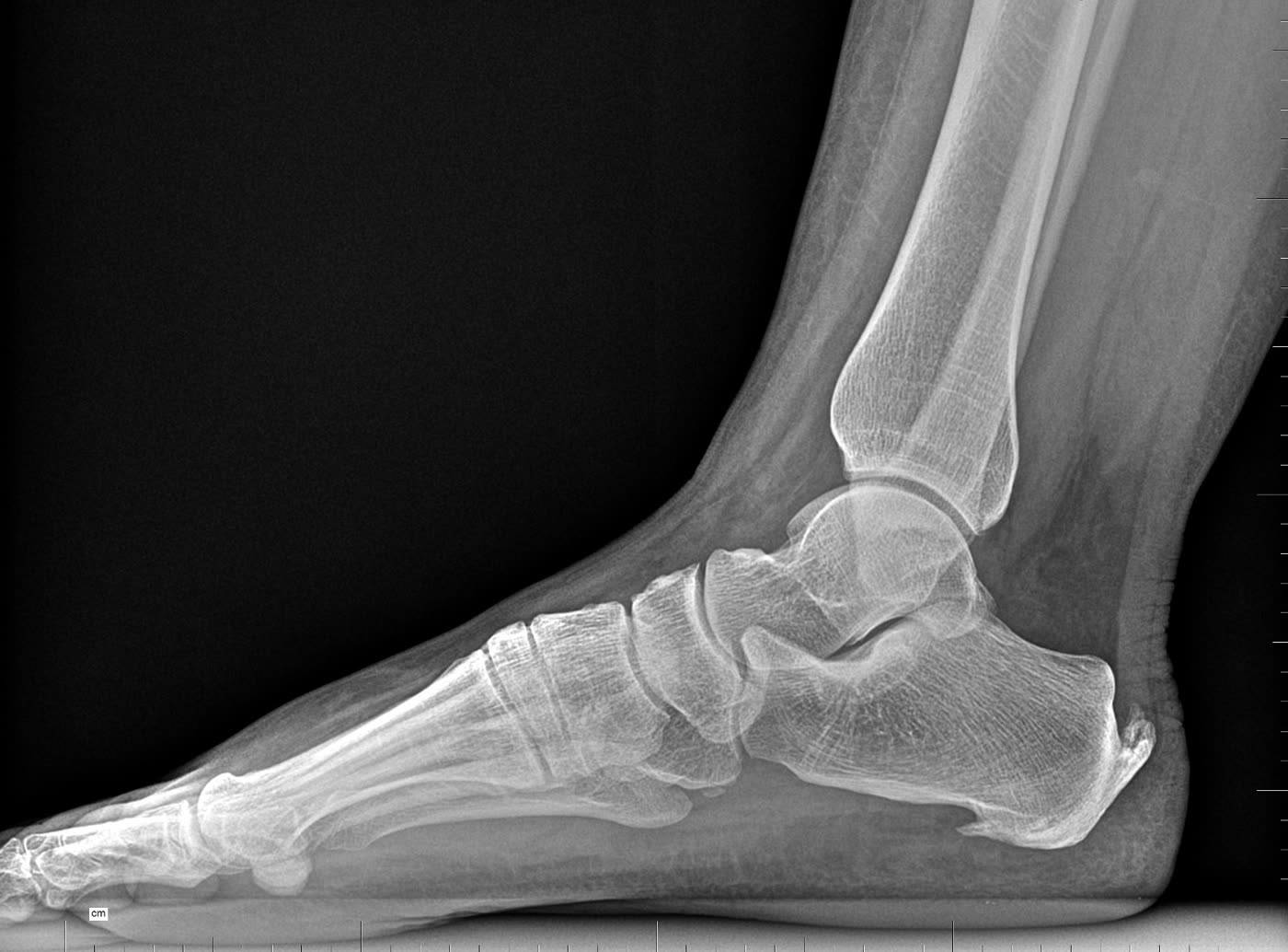 Radiografía pie — proyección dorso-plantar