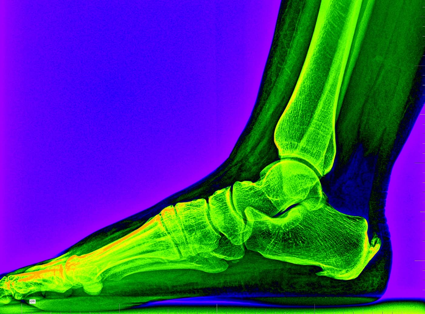 Radiografía pie — proyección lateral